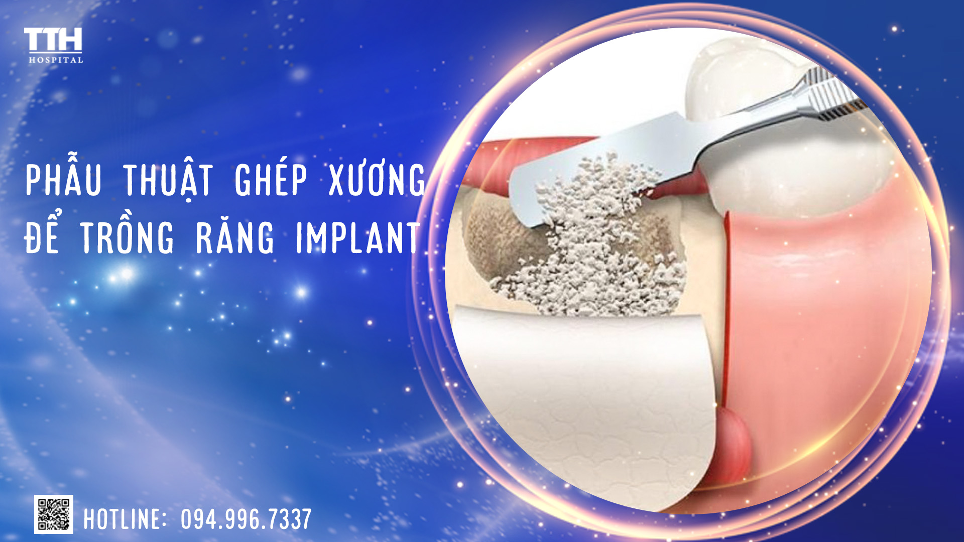 Ghép xương để trồng răng Implant tại Nghệ An